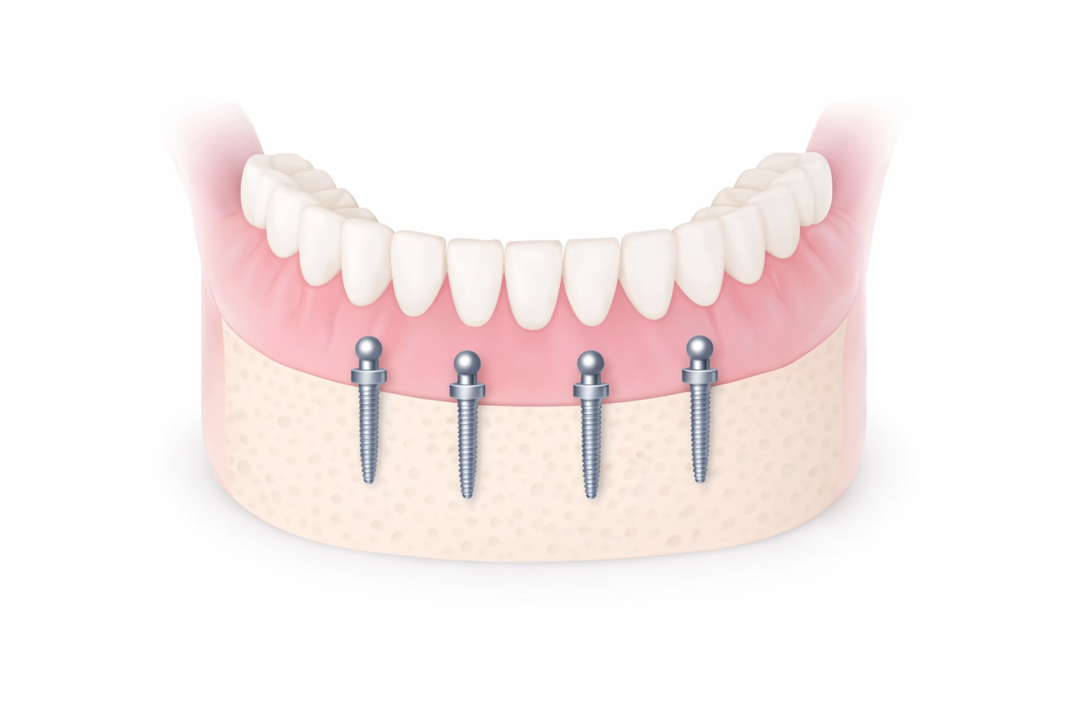 Miniimplantate Unterkiefer